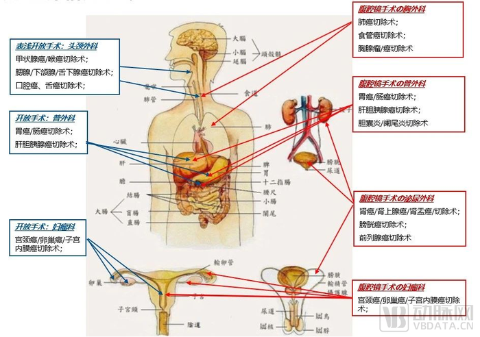 国产超声刀行业进入“新牌局”